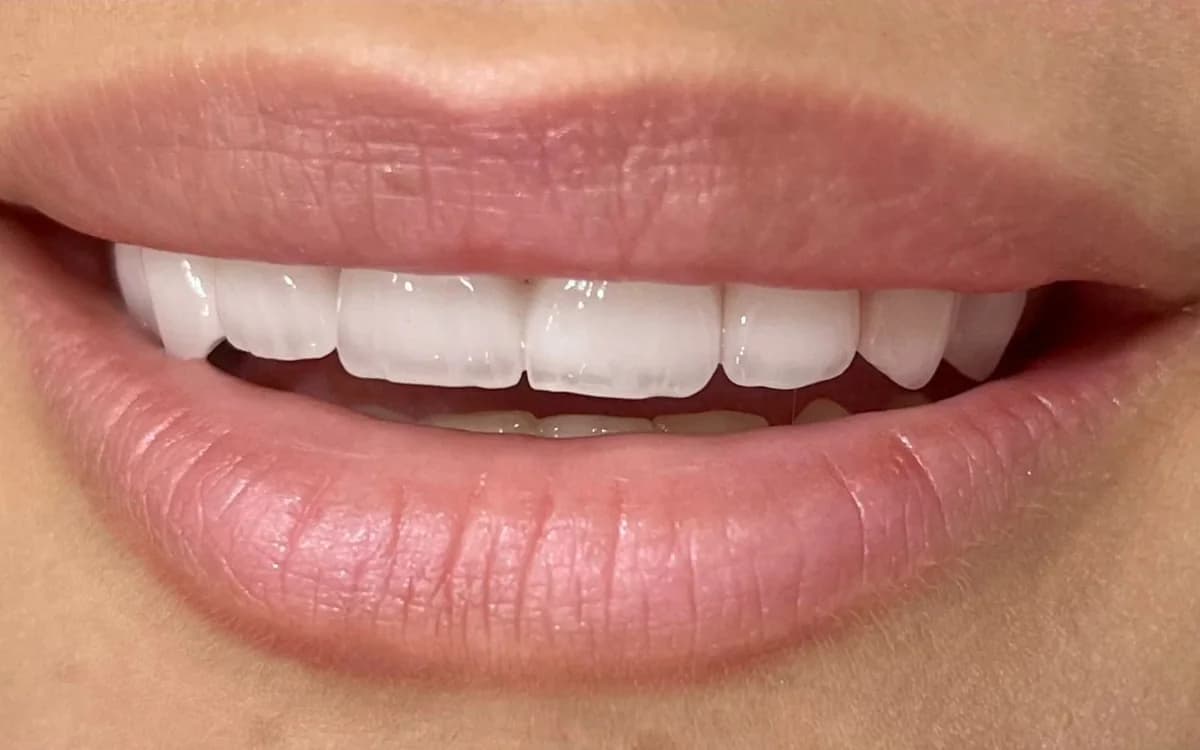 After: Aesthetic smile restoration — ceramic crowns