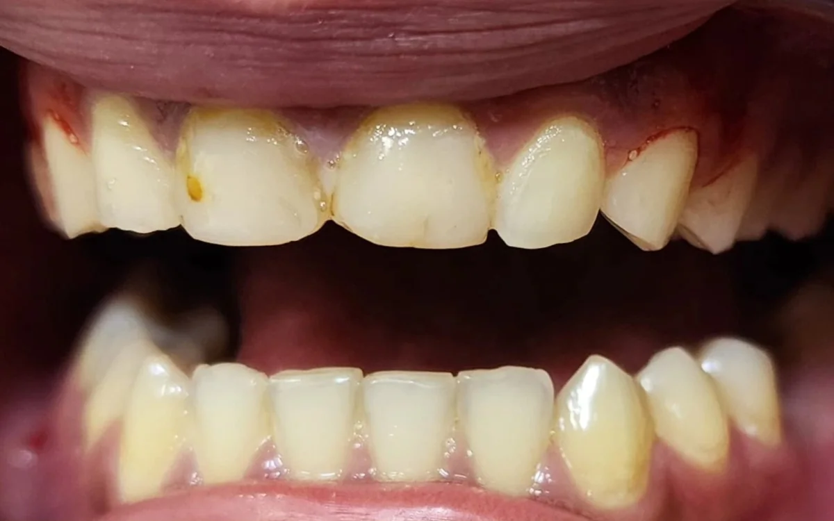 Before: Aesthetic smile restoration — ceramic crowns