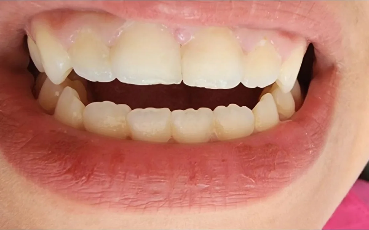 After: Fractured front teeth — direct composite restoration