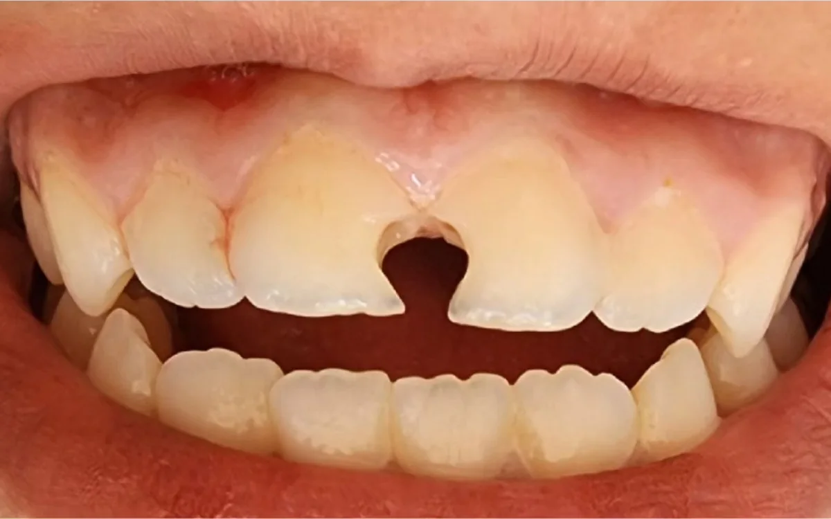 Before: Fractured front teeth — direct composite restoration