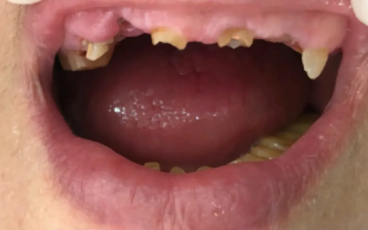 Before: Full-mouth rehabilitation — crowns & bridges